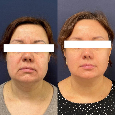 RF-лифтинг лица на аппарате Morpheus8 - фото до и после процедуры в клинике косметологии Effi в Красноярске. У пациента тон лица стал более ровный, скулы более четкие, овал лица подтянулся, подтянулись морщинки