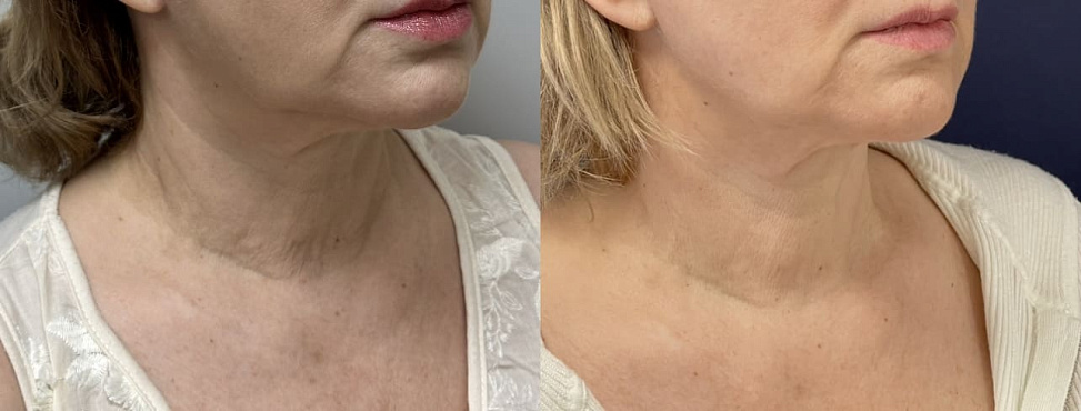 RF-лифтинг шеи - фото до и после процедуры в клинике косметологии Effi в Красноярске. У пациентки заметно подтянулась область шеи, ушли заломы