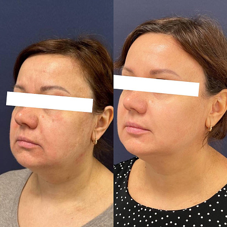 RF-лифтинг лица - фото до и после процедуры в клинике косметологии Effi в Красноярске. У пациента тон лица стал более ровный, скулы более четкие, овал лица подтянулся, подтянулись морщинки