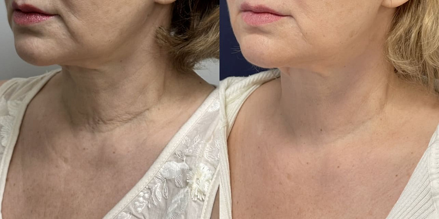 RF-лифтинг шеи - фото до и после процедуры в клинике косметологии Effi в Красноярске. У пациентки заметно ушли заломы, кольца венеры. Вид стал более молодой