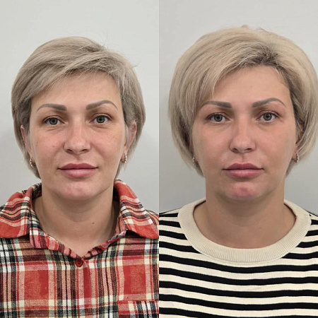 RF-лифтинг на аппарате DeAge - фото до и после процедуры в клинике косметологии Effi в Красноярске.