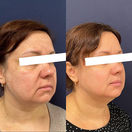 RF-лифтинг лица - фото до и после процедуры в клинике косметологии Effi в Красноярске. У пациента тон лица стал более ровный, скулы более четкие, овал лица подтянулся