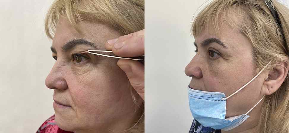 Блефаропластика - Фото до и после процедуры пластика век в клинике косметологии Effi в Красноярске. У пациента 9 сделана пластика верхних век (вид с боку)