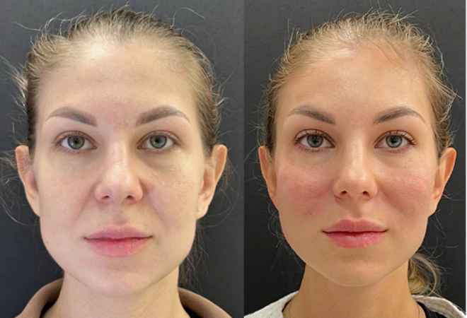 RF-лифтинг лица - фото до и после процедуры в клинике косметологии Effi в Красноярске. У пациента тон лица стал более ровный