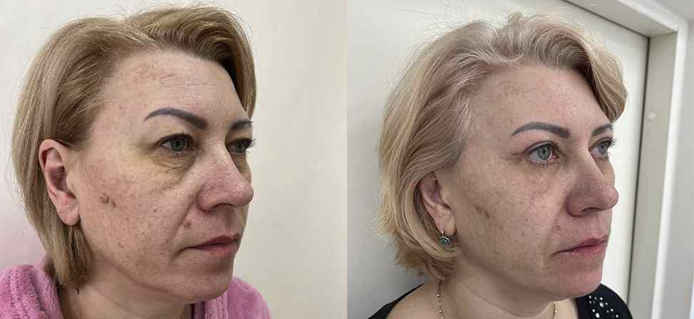 Блефаропластика - Фото до и после процедуры пластика век в клинике косметологии Effi в Красноярске. У пациента 7 сделана пластика верхних век