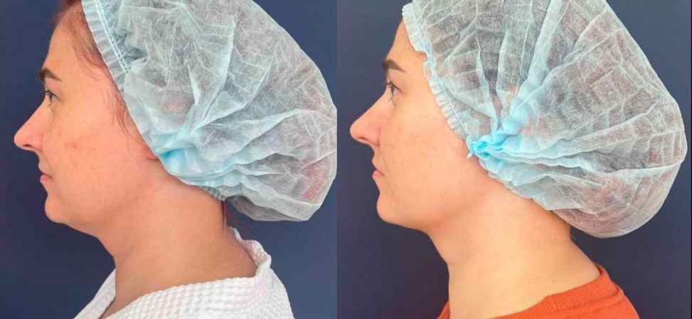 Лазерный липолиз подбородка - Фото до и после процедуры лазерного липолиза подбородка в клинике косметологии Effi в Красноярске. У пациента заметно стал четкий овал лица