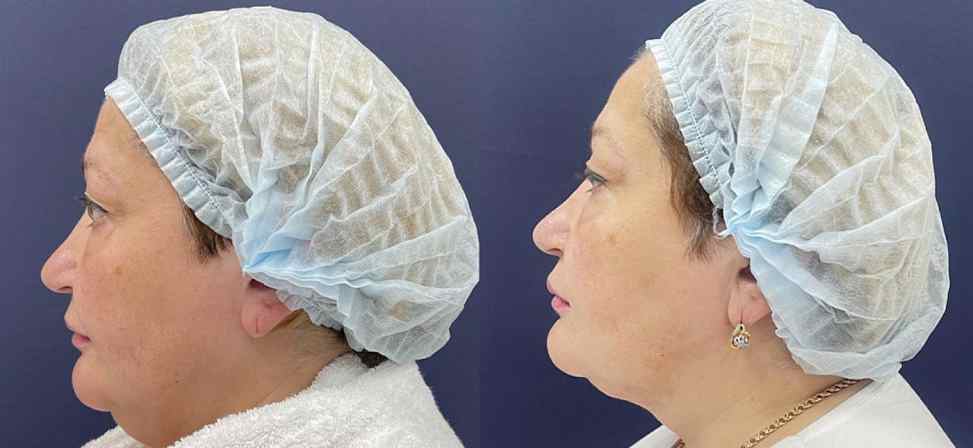 Лазерный липолиз подбородка - Фото до и после процедуры лазерного липолиза подбородка в клинике косметологии Effi в Красноярске. У пациента заметно после 1 процедуры стал четкий овал лица, второй подбородок ушел (вид с боку)