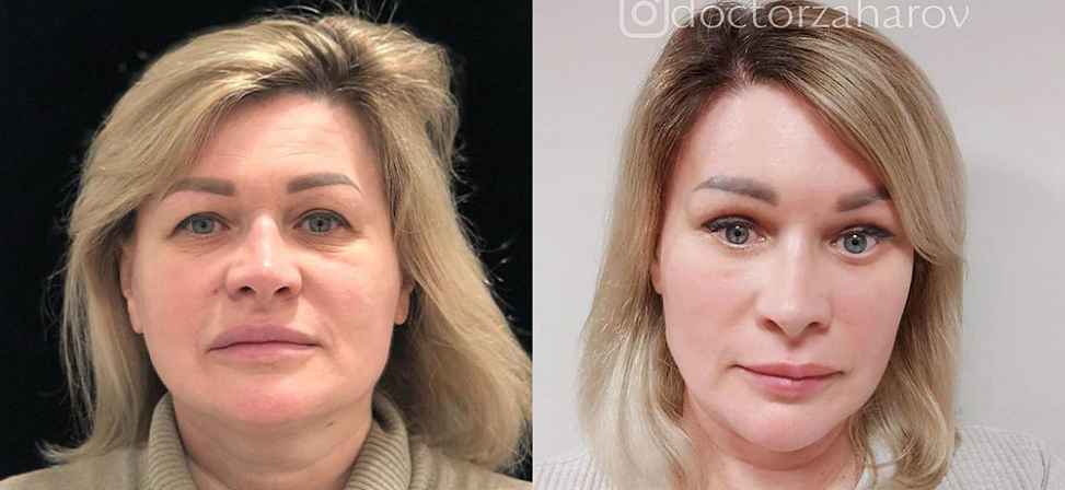 Блефаропластика - Фото до и после процедуры пластика век в клинике косметологии Effi в Красноярске. У пациента 13