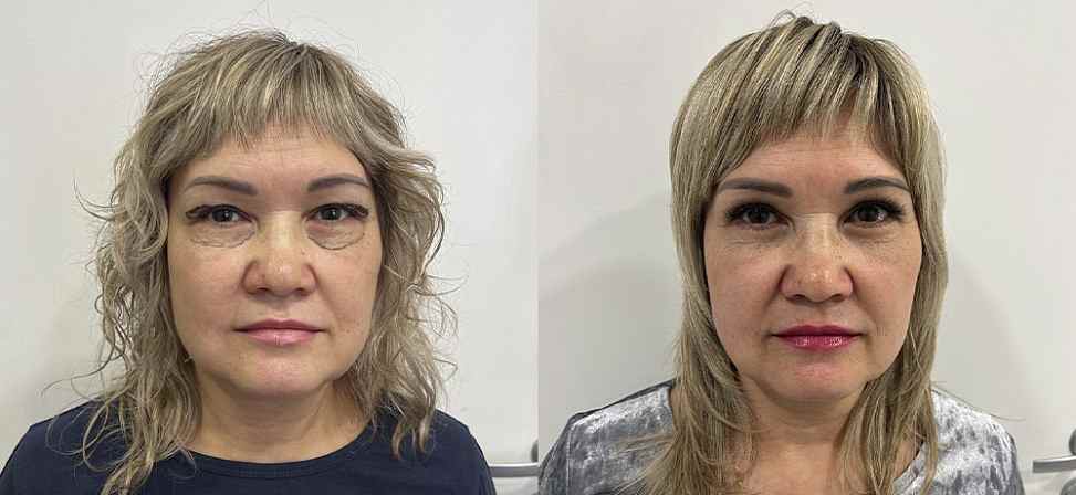 Блефаропластика - Фото до и после процедуры пластика век в клинике косметологии Effi в Красноярске. У пациента 8