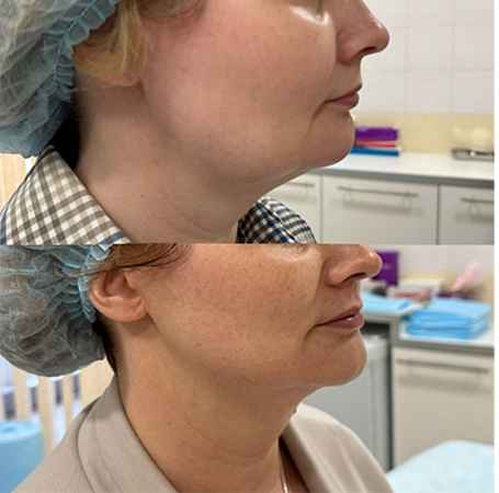 RF-лифтинг лица - фото до и после процедуры в клинике косметологии Effi в Красноярске. У пациента подтянулся овал лица и скулы, ушел второй подбородок