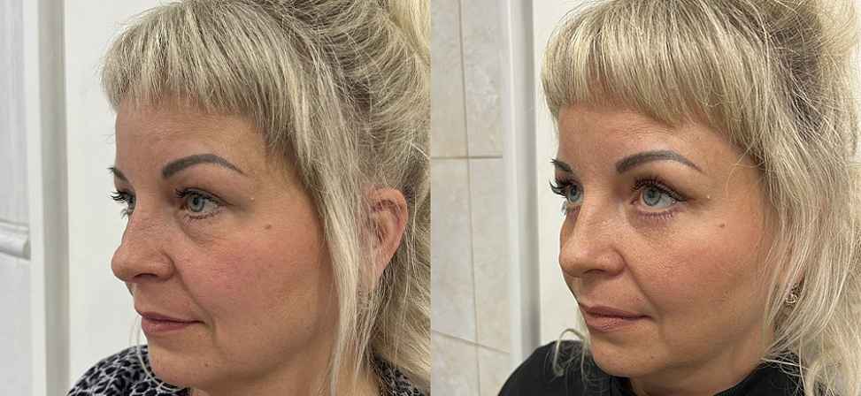 Блефаропластика - Фото до и после процедуры пластика век в клинике косметологии Effi в Красноярске. У пациента 12 сделана пластика верхних век (вид с боку)