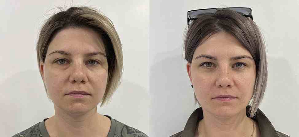 Блефаропластика - Фото до и после процедуры пластика век в клинике косметологии Effi в Красноярске. У пациента 16