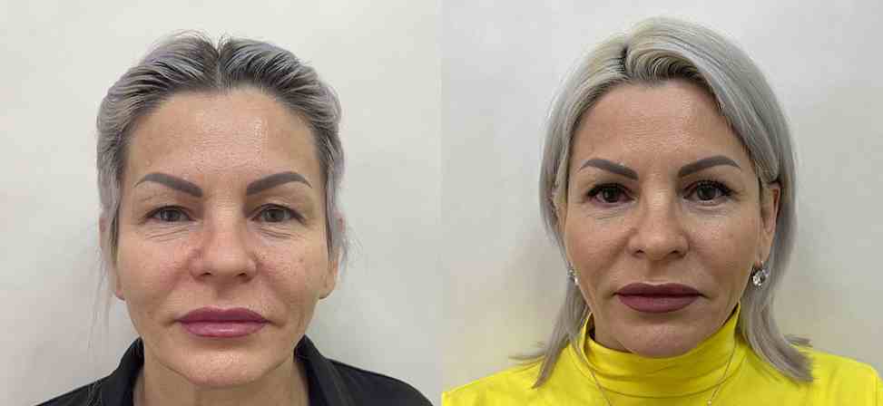 Блефаропластика - Фото до и после процедуры пластика век в клинике косметологии Effi в Красноярске. У пациента 11