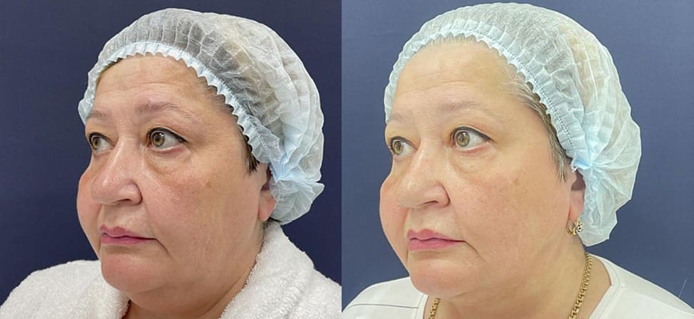 Лазерный липолиз подбородка - Фото до и после процедуры лазерного липолиза подбородка в клинике косметологии Effi в Красноярске. У пациента заметно после 1 процедуры подтянулась область подбородка (вид с боку)