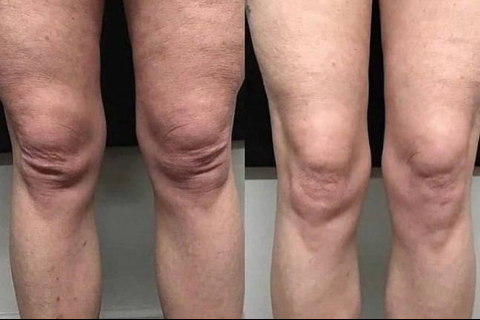 Фото до и после процедуры рф-лифтинга коленей у женщины колени стали выглядеть подтянутыми и молодыми в клинике Еffi в Красноярске.