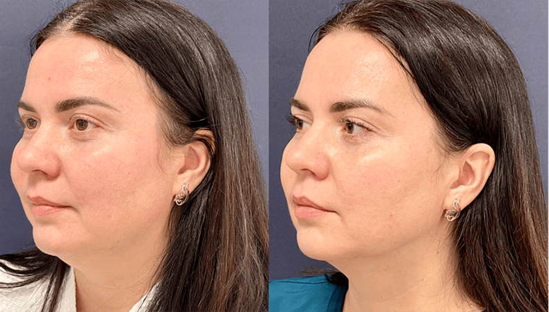 Лазерный липолиз подбородка - Фото до и после процедуры лазерного липолиза подбородка в клинике косметологии Effi в Красноярске. У пациента заметно после 1 процедуры подтянулся контур лица (вид с боку)