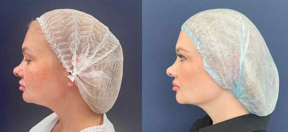 Лазерный липолиз подбородка - Фото до и после процедуры лазерного липолиза подбородка в клинике косметологии Effi в Красноярске. У пациента заметно корректировался контур лица вид с боку, контуры более четкие овала лица