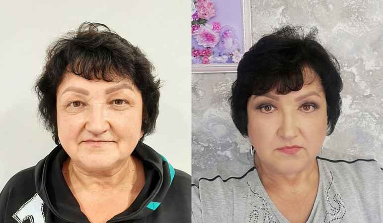 Блефаропластика - Фото до и после процедуры пластика век в клинике косметологии Effi в Красноярске. У пациента 4 сделана пластика круговая век