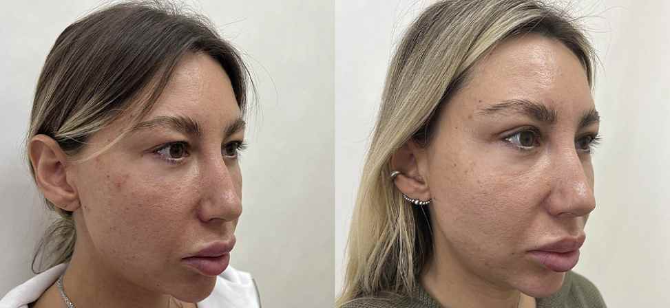 Блефаропластика - Фото до и после процедуры пластика век в клинике косметологии Effi в Красноярске. У пациента 6 сделана пластика верхних век (вид с боку)