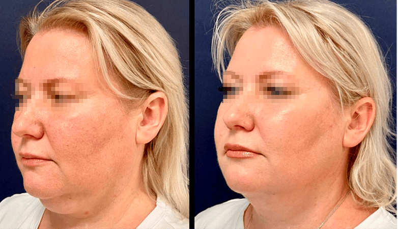 RF-лифтинг лица - фото до и после процедуры в клинике косметологии Effi в Красноярске. У пациентки овал лица стал более четкий, тон более ровный, подтянулись морщинки, скулы более четкие