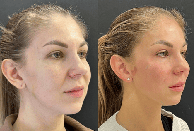 RF-лифтинг лица - фото до и после процедуры в клинике косметологии Effi в Красноярске. У пациента тон лица стал более ровный, скулы более четкие