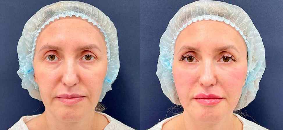 Игольчатый rf лифтинг - Фото лица женщины прямо до и после процедуры в клинике Еffi в Красноярске. На пациенте видно, что морщины подтянулись. Наши врачи имеют большой опыт работы в этой области постоянно совершенствуются повышением квалификации.