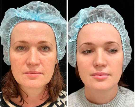 RF-лифтинг лица - фото до и после процедуры в клинике косметологии Effi в Красноярске. У пациента подтянулся овал лица и скулы