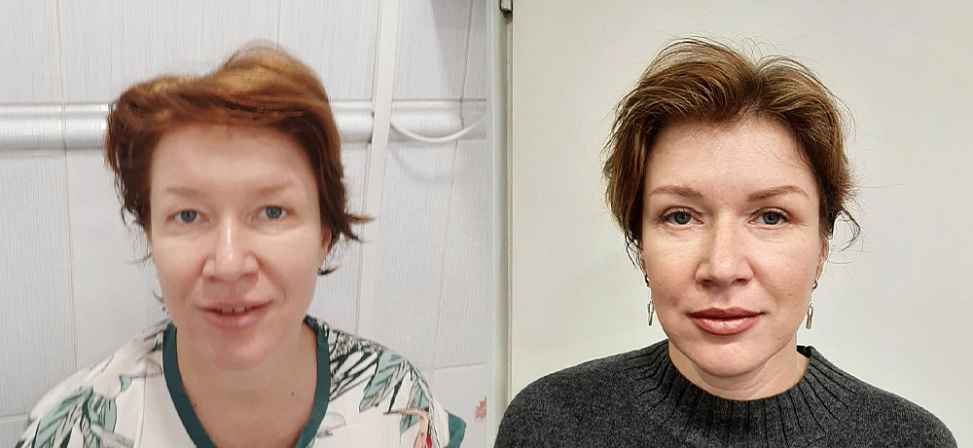 Блефаропластика - Фото до и после процедуры пластика век в клинике косметологии Effi в Красноярске. У пациента 21
