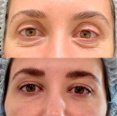 RF-лифтинг лица - фото до и после процедуры в клинике косметологии Effi в Красноярске. У пациентки ушли глубокие морщинки у глаз