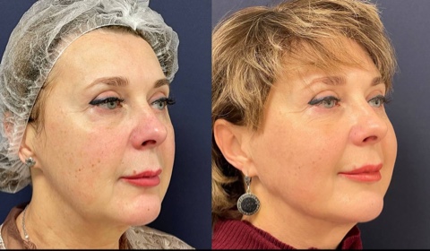 Игольчатый rf лифтинг лица - Фото до и после процедуры в клинике Еffi в Красноярске. У пациента заметно  стал более четким контур лица, подтянулись скулы