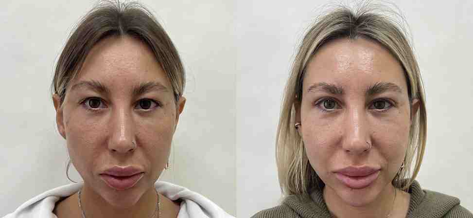 Блефаропластика - Фото до и после процедуры пластика век в клинике косметологии Effi в Красноярске. У пациента 6 сделана пластика верхних век