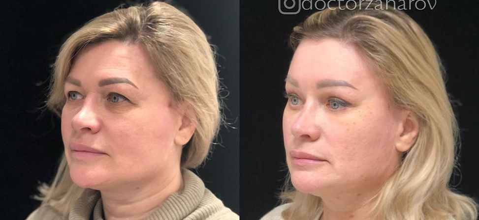Блефаропластика - Фото до и после процедуры пластика век в клинике косметологии Effi в Красноярске. У пациента 13 сделана пластика круговая век