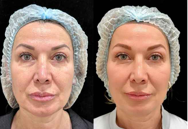 RF-лифтинг лица - фото до и после процедуры в клинике косметологии Effi в Красноярске. Овал лица стал более четкий, кожа подтянулась, ушли глубокие морщины