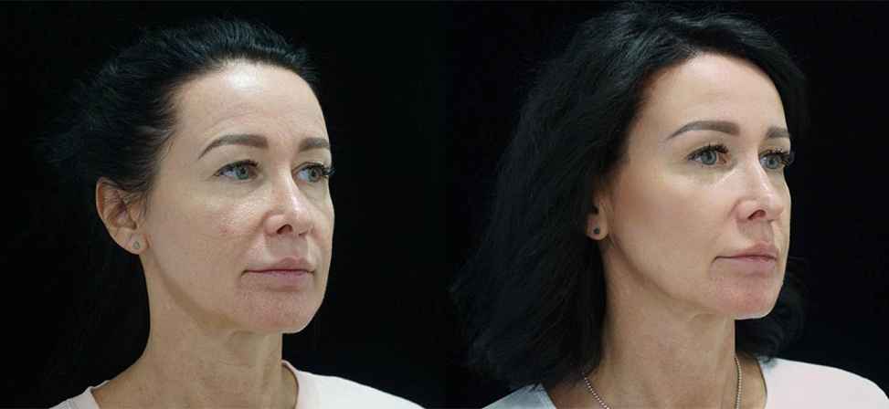 Игольчатый rf лифтинг лица - Фото лица с боку до и после процедуры в клинике Еffi в Красноярске. На пациенте видно, что лицо стало более молодым. Наши врачи имеют большой опыт работы в этой области постоянно совершенствуются повышением квалификации.