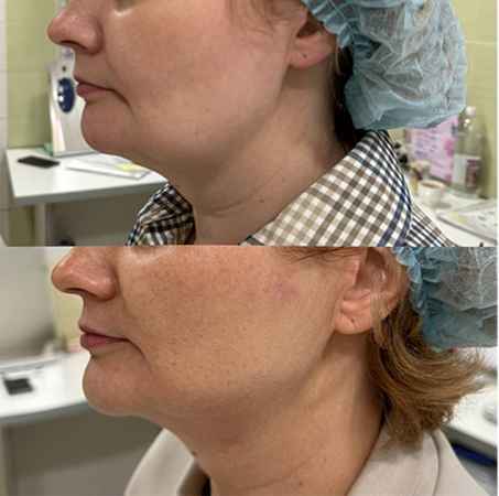 RF-лифтинг лица - фото до и после процедуры в клинике косметологии Effi в Красноярске. У пациента подтянулся овал лица и скулы и шея, ушел второй подбородок