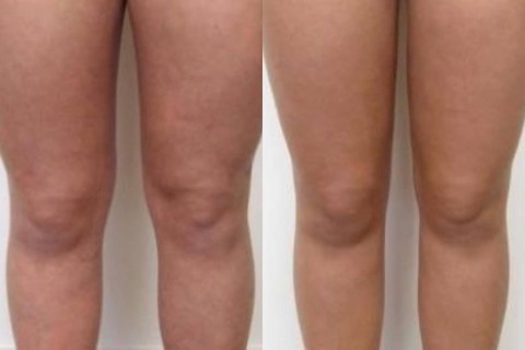 Фото до и после процедуры рф-лифтинга коленей у женщины в клинике Еffi в Красноярске.