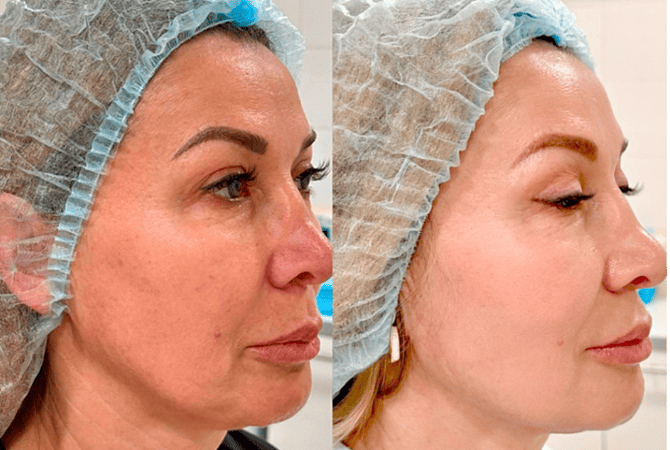 RF-лифтинг лица - фото до и после процедуры в клинике косметологии Effi в Красноярске. Овал лица стал более четкий, кожа подтянулась, подбородок стал более четкий, тон стал более ровный