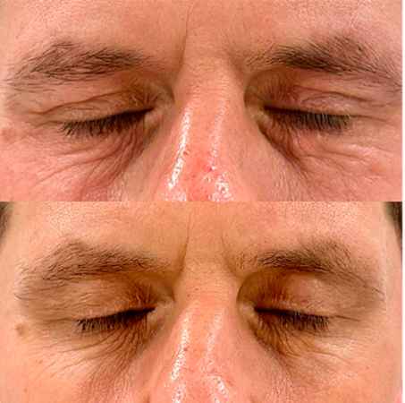 RF-лифтинг лица - фото до и после процедуры в клинике косметологии Effi в Красноярске. У пациента ушли глубокие морщины у глаз и межбровные