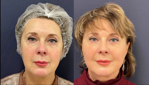 Игольчатый rf лифтинг лица - Фото до и после процедуры в клинике Еffi в Красноярске. У пациента заметно  стал более четким контур лица