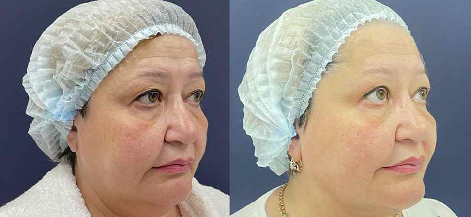 Лазерный липолиз подбородка - Фото до и после процедуры лазерного липолиза подбородка в клинике косметологии Effi в Красноярске. У пациента заметно после 1 процедуры ушел второй подбородок ушел (вид с боку)