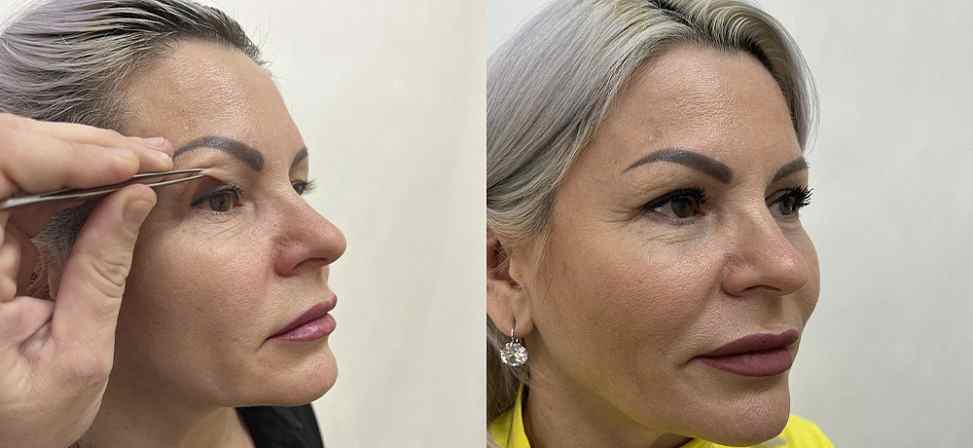 Блефаропластика - Фото до и после процедуры пластика век в клинике косметологии Effi в Красноярске. У пациента 11 сделана пластика верхних век