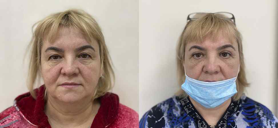 Блефаропластика - Фото до и после процедуры пластика век в клинике косметологии Effi в Красноярске. У пациента 9