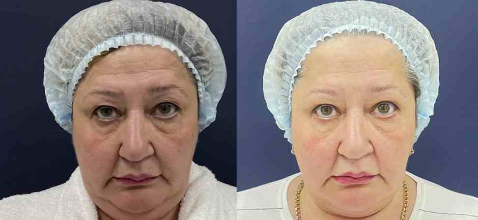 Лазерный липолиз подбородка - Фото до и после процедуры лазерного липолиза подбородка в клинике косметологии Effi в Красноярске. У пациента заметно после 1 процедуры стал четкий овал лица, второй подбородок ушел