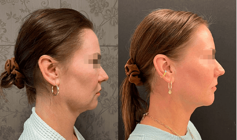 RF-лифтинг лица - фото до и после процедуры в клинике косметологии Effi в Красноярске. У пациентки овал лица стал более четкий, тон более ровный