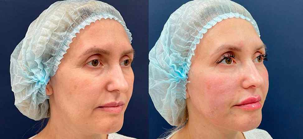 Игольчатый rf лифтинг - Фото лица женщины до и после процедуры в клинике Еffi в Красноярске. На пациенте видно, что морщины подтянулись. Наши врачи имеют большой опыт работы в этой области постоянно совершенствуются повышением квалификации.