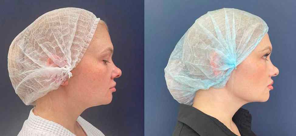 Лазерный липолиз подбородка - Фото до и после процедуры лазерного липолиза подбородка в клинике косметологии Effi в Красноярске. У пациента заметно корректировался контур лица вид с боку