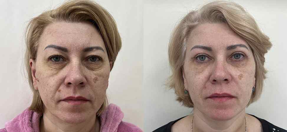 Блефаропластика - Фото до и после процедуры пластика век в клинике косметологии Effi в Красноярске. У пациента 7