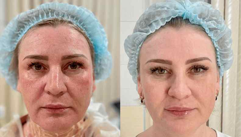 Игольчатый rf лифтинга - Фото лица до и после процедуры  в клинике Еffi в Красноярске. На пациенте видно, что лицо стало более подтянутым и тон кожи более ровный. Наши врачи имеют большой опыт работы в этой области постоянно совершенствуются повышением кв