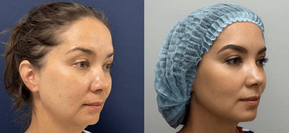 Лазерный липолиз подбородка - Фото до и после процедуры лазерного липолиза подбородка в клинике косметологии Effi в Красноярске. У пациента заметно после 1 процедуры подтянулся контур лица, на вид стало более подтянутым  (вид с боку)