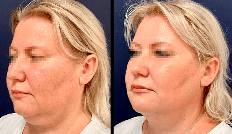 Лазерный липолиз подбородка - Фото до и после процедуры лазерного липолиза подбородка в клинике косметологии Effi в Красноярске. У пациента заметно после 1 процедуры подтянулся контур лица, лицо стало более подтянутым (вид прямо)